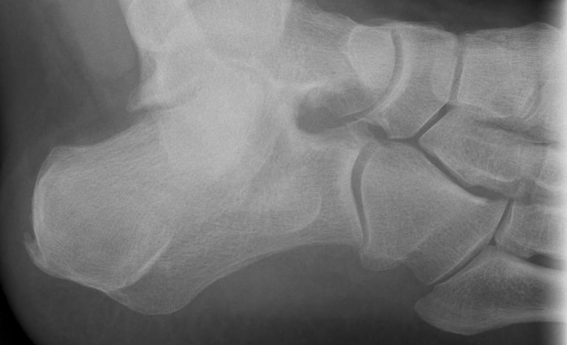 Calcaneum Anterior Process Fracture